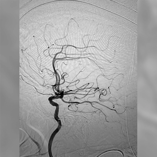 angiogram of cleared blood vessel
