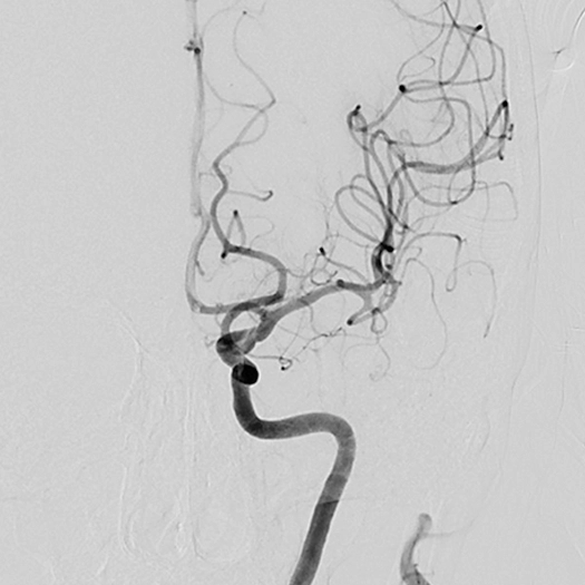 angiogram of cleared blood vessel