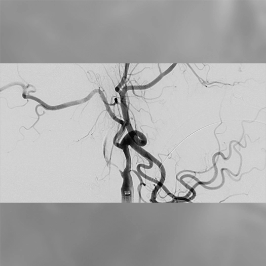 angiogram of occluded blood vessel