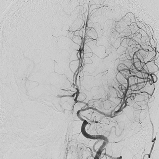 angiogram of cleared blood vessel