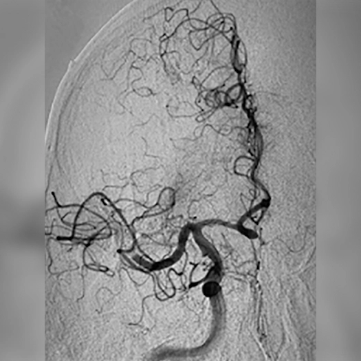 angiogram of occluded blood vessel