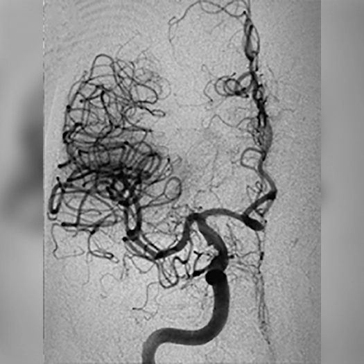 angiogram of cleared blood vessel