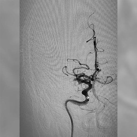 angiogram of occluded blood vessel