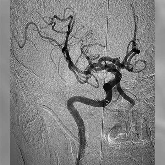 angiogram of cleared blood vessel