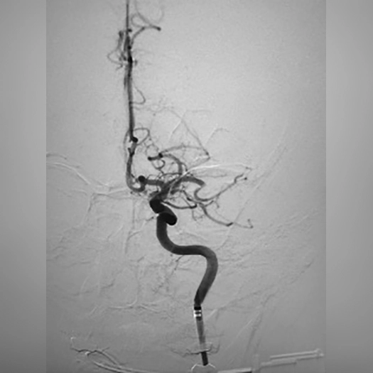 angiogram of occluded blood vessel