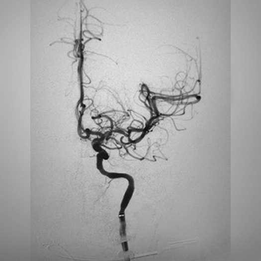 angiogram of cleared blood vessel