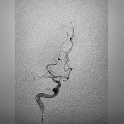 angiogram of occluded blood vessel
