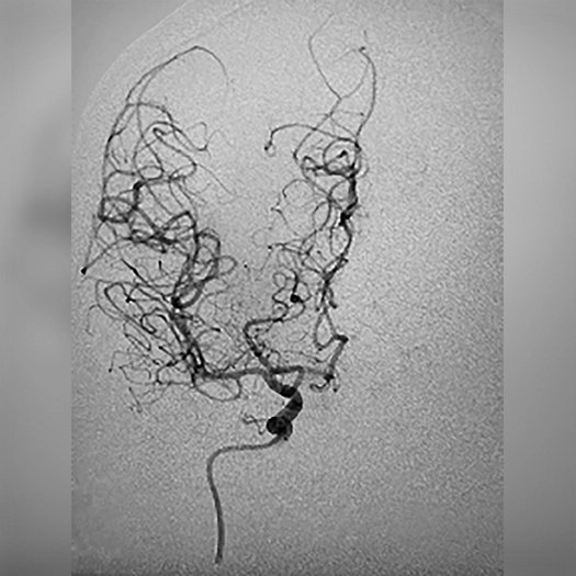 angiogram of cleared blood vessel