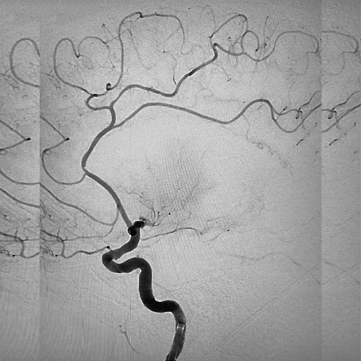angiogram of occluded blood vessel