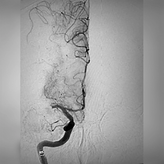 angiogram of occluded blood vessel