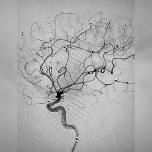 angiogram of cleared blood vessel