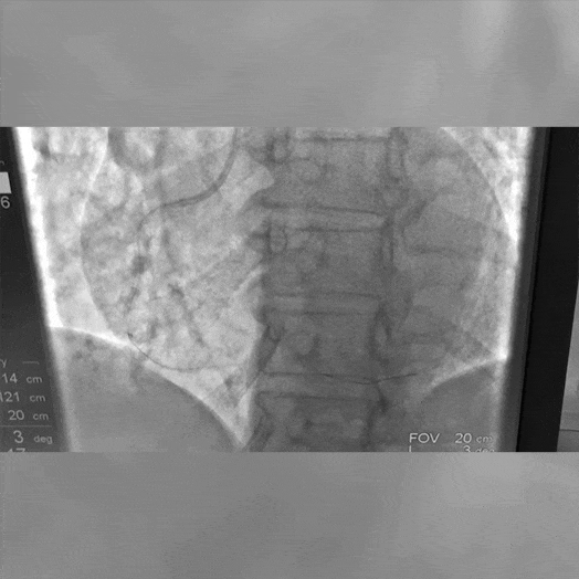 angiogram of cat rx in the vessel