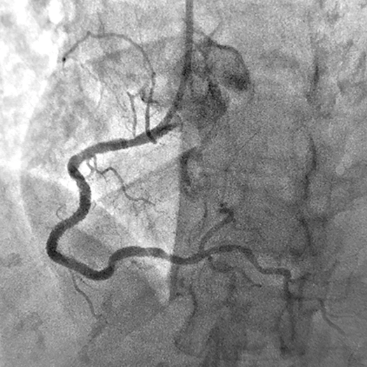 Angiogram of a restored blood flow in the right coronary artery