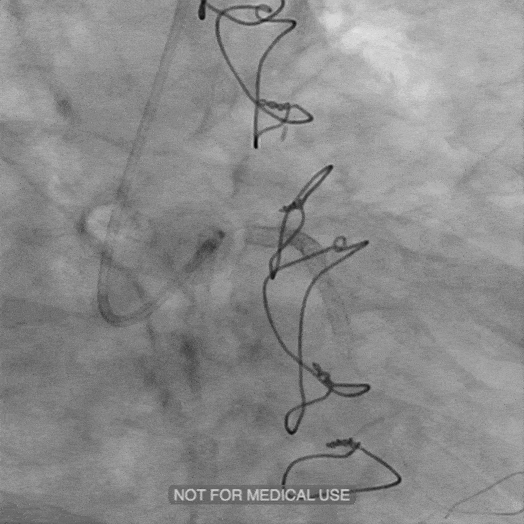 angiogram animation of cat rx tracking in a blood vessel