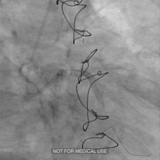 Angiogram animation of cleared blood vessel