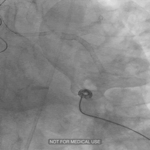 angiogram animation of restored blood flow in a vessel