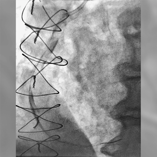 Angiogram of an occluded vessel