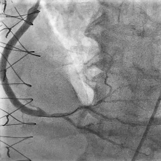 angiogram of restored blood flow in vessel