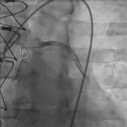 angiogram animation of occluded blood vessel
