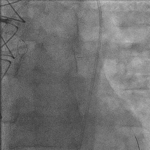 Angiogram animation of cleared blood vessel