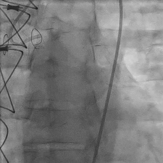 angiogram animation of restored blood flow in a vessel