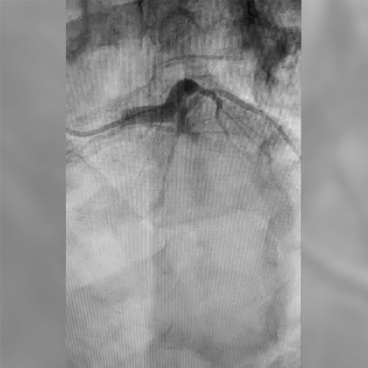 Angiogram of an occluded vessel in an LCx artery