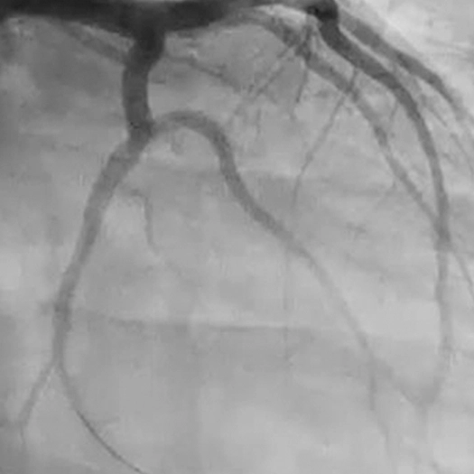 Angiogram of a cleared vessel in an LCx artery