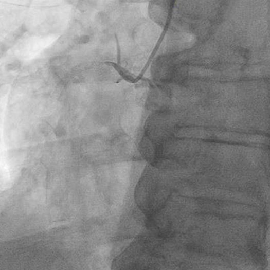 angiogram of occluded blood vessel