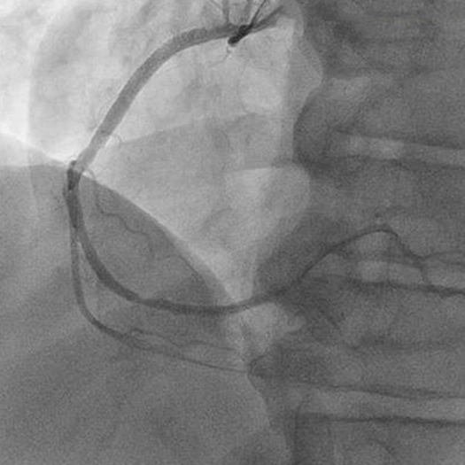 angiogram of restored blood flow in a vessel