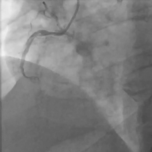 Angiogram of an occluded vessel in the right coronary artery