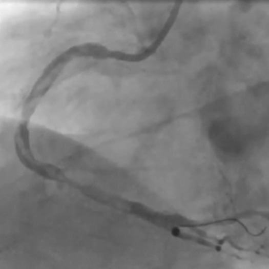 Angiogram of a vessel post balloon in the right coronary artery
