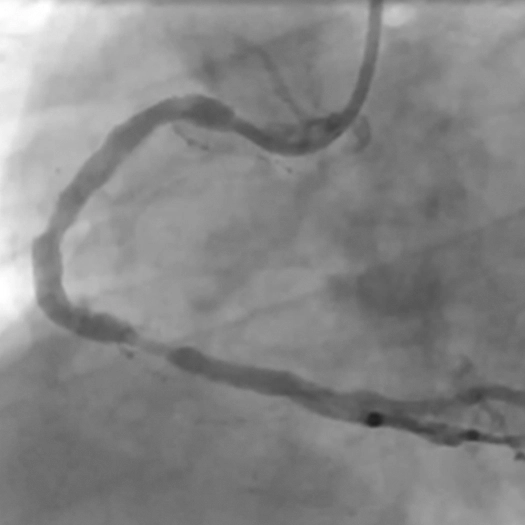 Angiogram of a cleared vessel in the right coronary artery