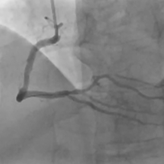 Angiogram of a restored blood flow in the right coronary artery