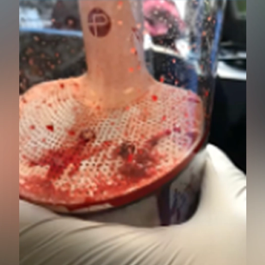 Blood clots collected in the penumbra engine canister