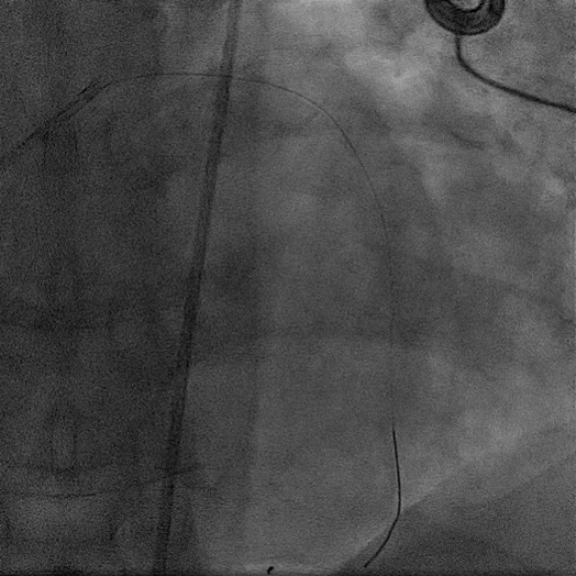 angiogram animation of cleared vessel