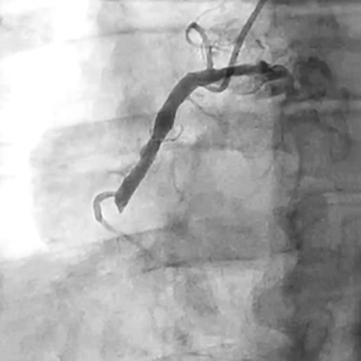 Angiogram of an occluded vessel in an Acutely Thrombotic RCA
