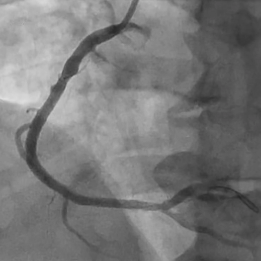 Angiogram of a cleared vessel in an Acutely Thrombotic RCA