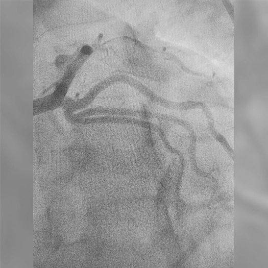 Angiogram of an occluded vessel in an LAD