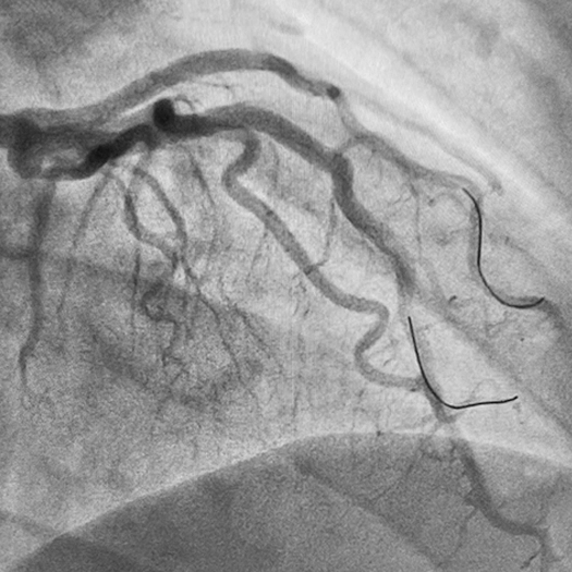Angiogram of a cleared vessel in an LAD