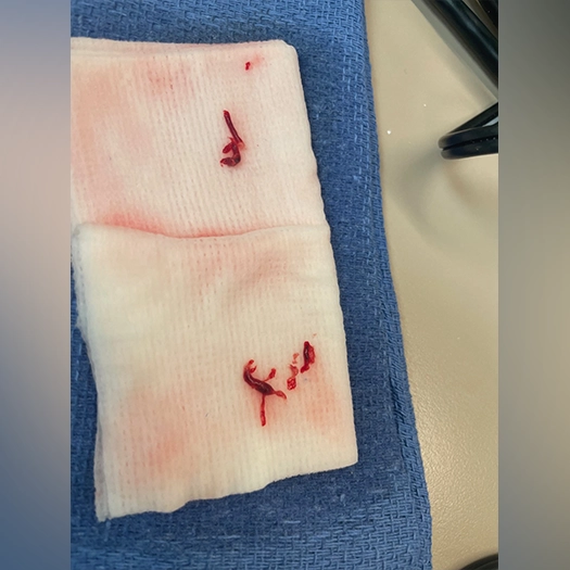 Blood clots on a gauze pad on a blue towel