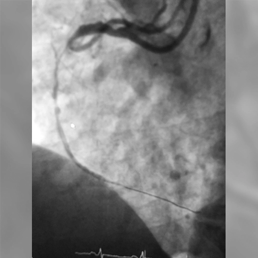 Angiogram of an occluded vessel in the right coronary artery