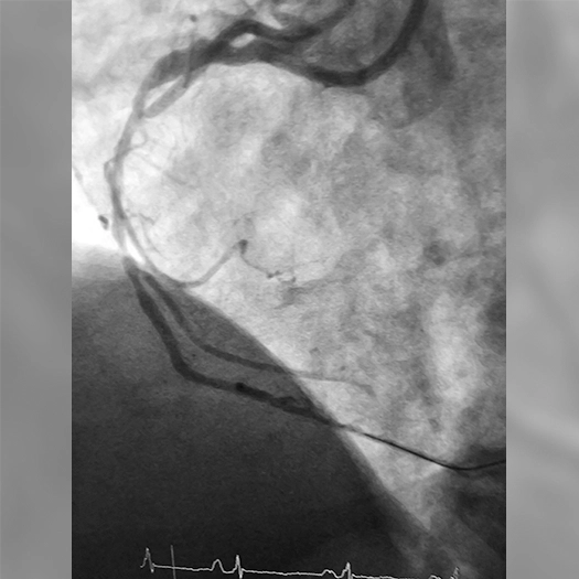 Angiogram of a cleared vessel in an Right Coronary Artery
