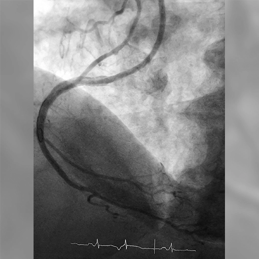 Angiogram of a restored blood flow in the right coronary artery