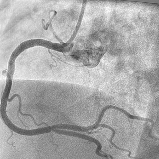 Angiogram of a restored blood flow in the right coronary artery