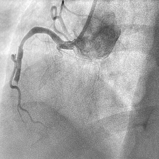 Angiogram of an occluded vessel in the right coronary artery