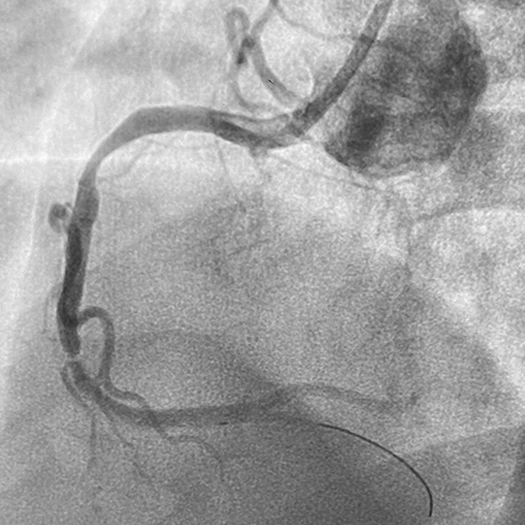 Angiogram of a cleared vessel in an Right Coronary Artery