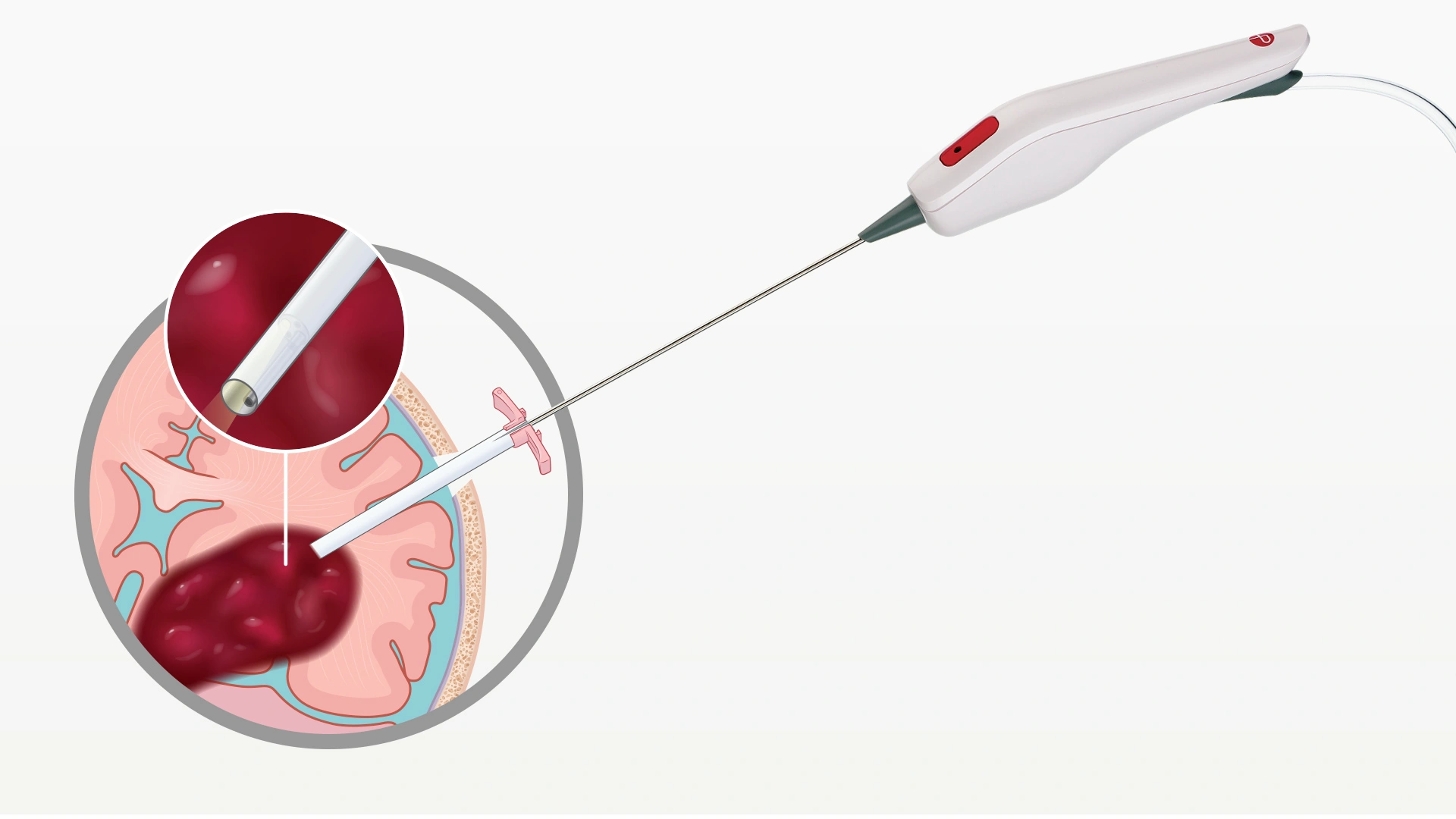 Illustration of Artemis in use on a brain