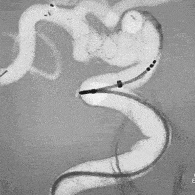 Angiogram of MIDWAY 43 in a vessel