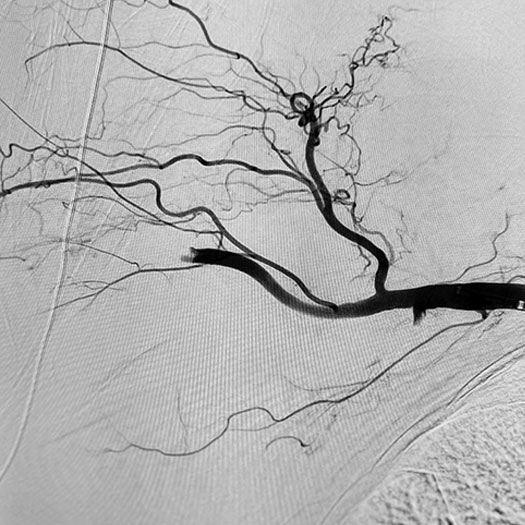 Angiogram of occluded blood vessel