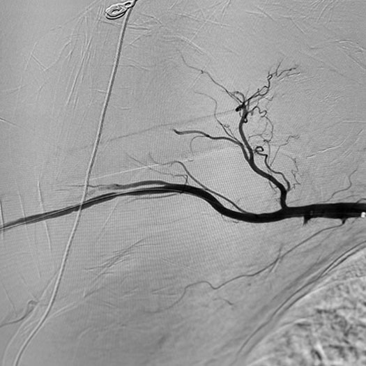 Angiogram of cleared blood vessel